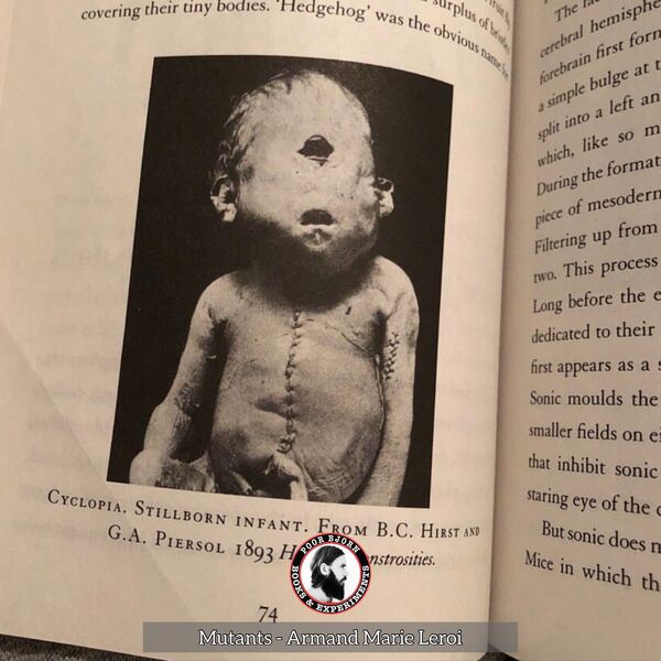 Cyclopia - stillborn infant, from Hirst and Piersol 1893